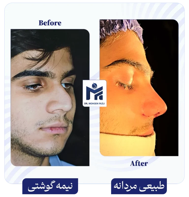 عمل بینی نیمه گوشتی به بینی طبیعی مردانه دکتر محسن فضلی