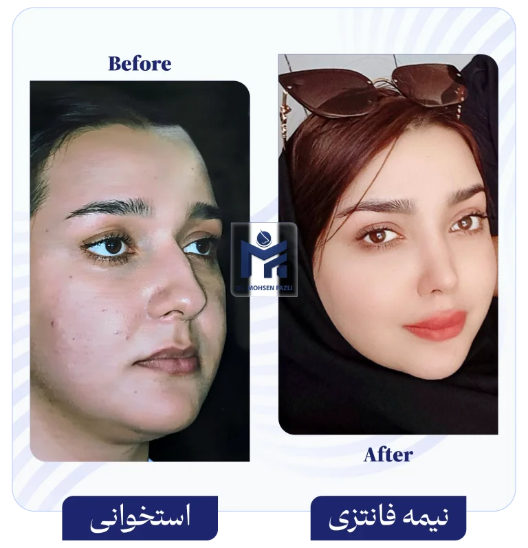 عمل بینی استخوانی به بینی نیمه فانتزی دکتر محسن فضلی