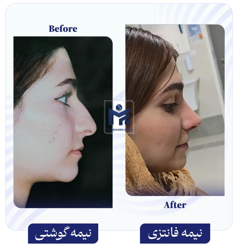 عمل بینی گوشتی به بینی نیمه فانتزی دکتر محسن فضلی
