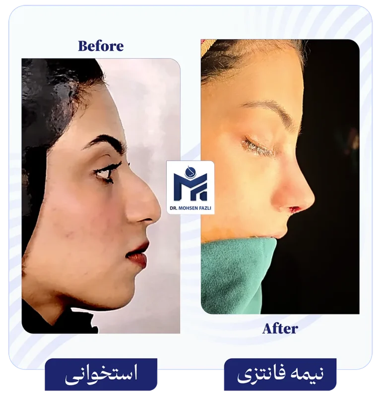 عمل بینی استخوانی به بینی نیمه فانتزی دکتر محسن فضلی