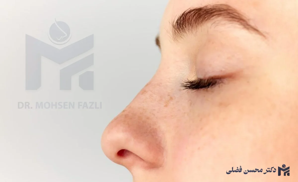 عمل بینی طبیعی یا نیمه فانتزی؟؛ مقایسه تفاوت و هزینه