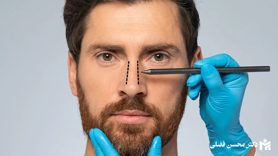 عمل بینی مردانه چگونه است؟ مزایا و معایب + هزینه 1404