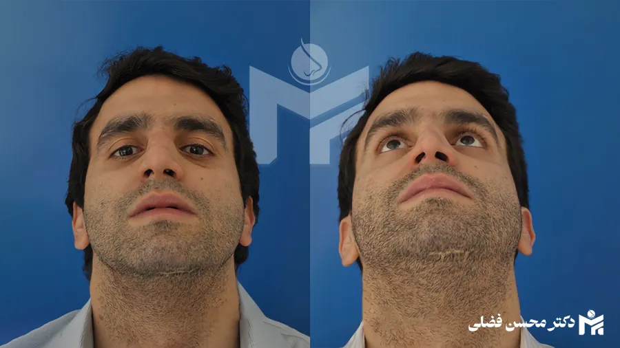 درمان شکستگی بینی با رینوپلاستی [دکتر محسن فضلی]