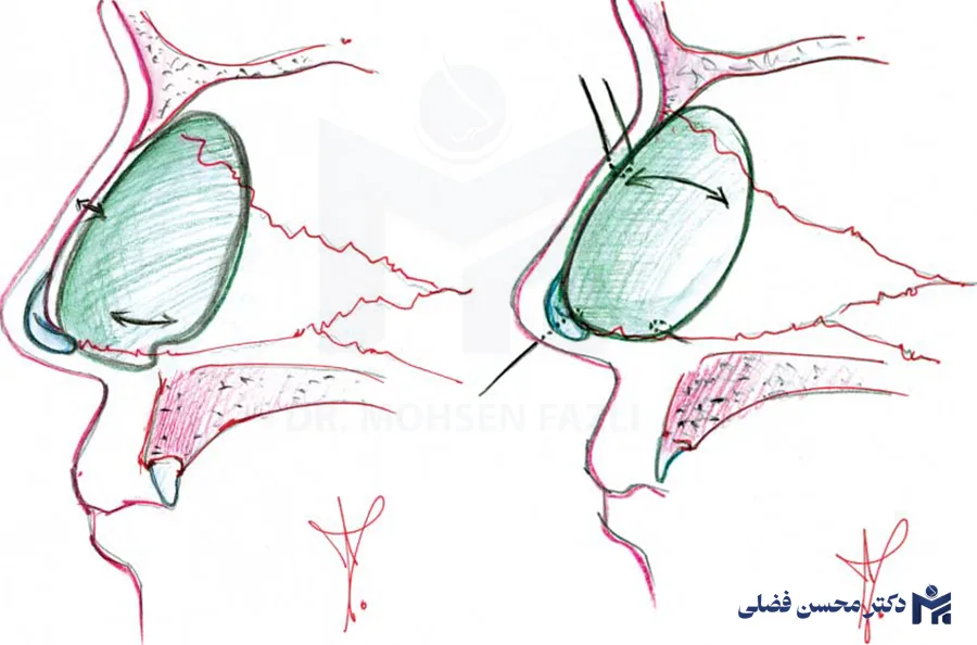 سپتوپلاستی خارج بینی برای انحراف شدید تیغه بینی