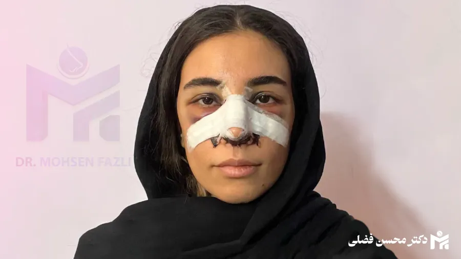مدت زمان رفع کبودی صورت بعد از عمل بینی