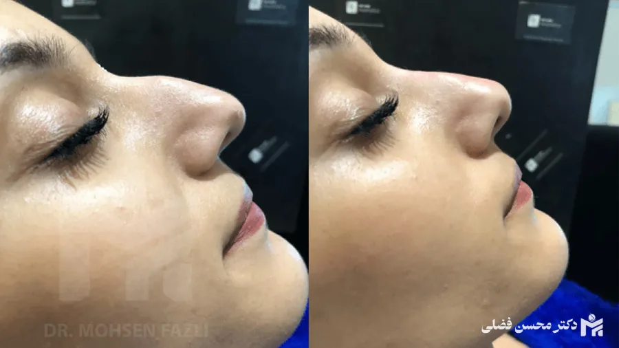 نحوه برداشتن قوز بینی با جراحی