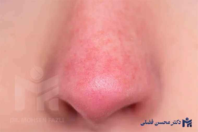 عوامل کاهش التهاب پوست بینی بعد از عمل