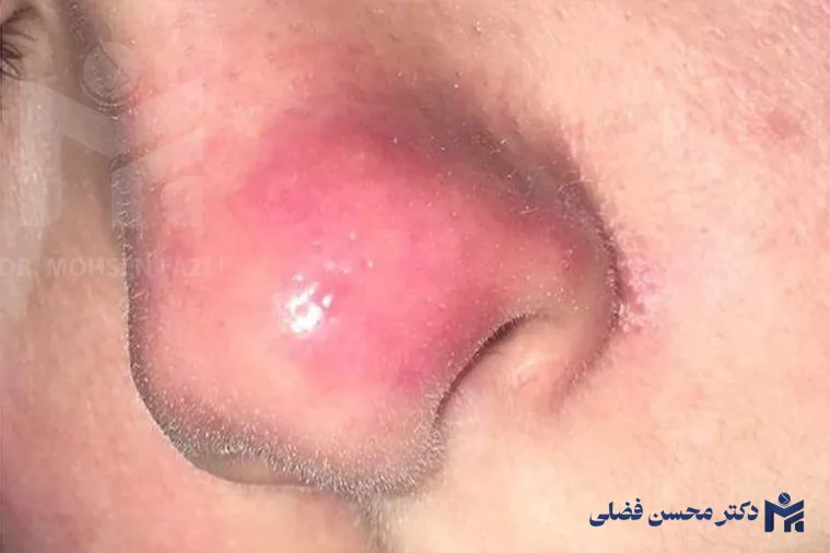عوامل کاهش التهاب پوست بینی بعد از عمل