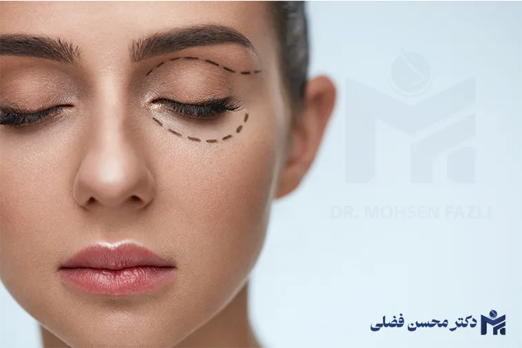 تفاوت بلفاروپلاستی لیزری و زیر جلدی؛ کدام بهتر است؟!