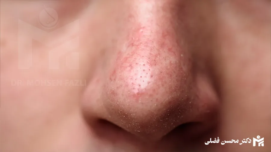 سرطان بینی چیست و چه علائمی دارد