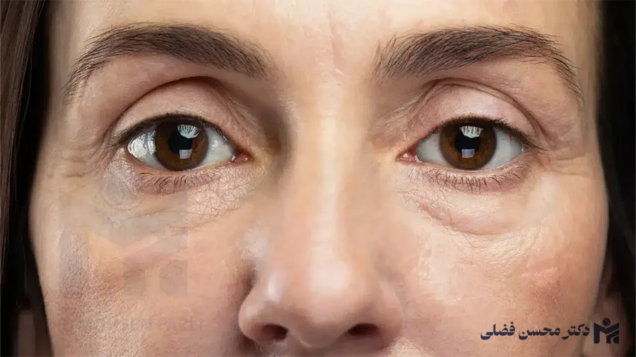 علت ایجاد پف زیر چشم؛ بهترین روش های برای درمان