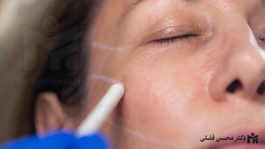 پروتز گونه یا ژل گونه؟؛ مقایسه مزایا، معایب و هزینه ها