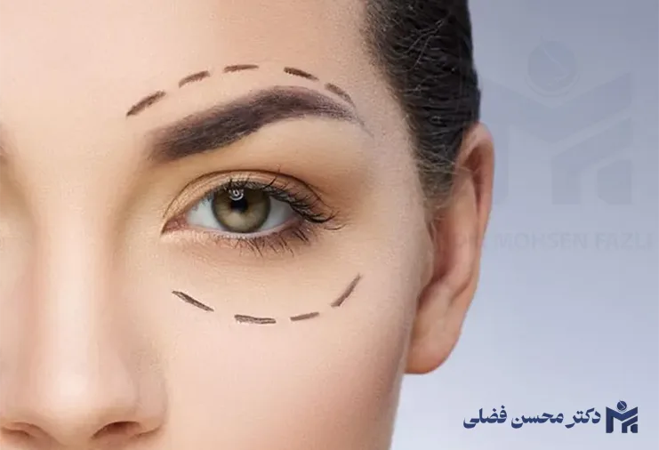 لیفت ابرو یا بلفاروپلاستی؟ کدام یک برای شما مناسب تر است؟