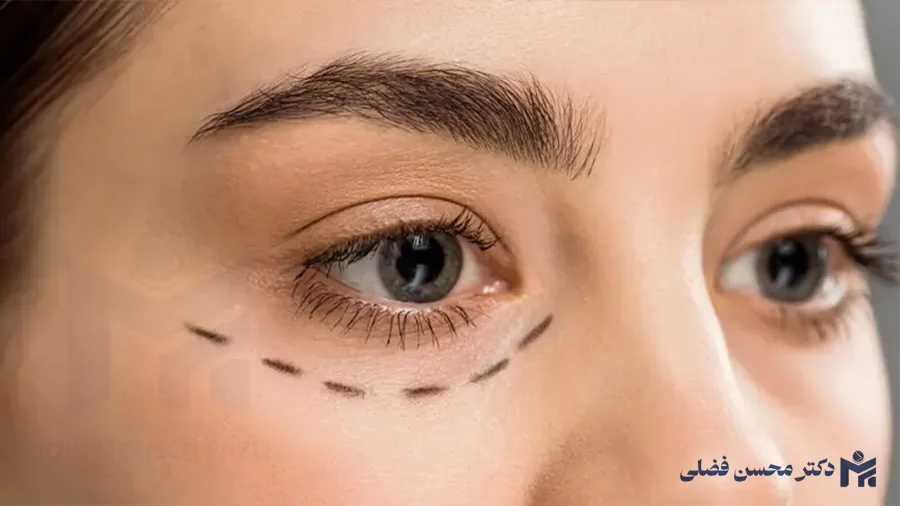 لیفت ابرو یا بلفاروپلاستی؟ کدام یک برای شما مناسب تر است؟