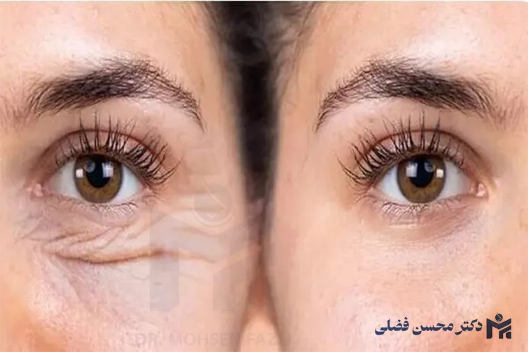 جوان سازی پلک با روش های غیرجراحی