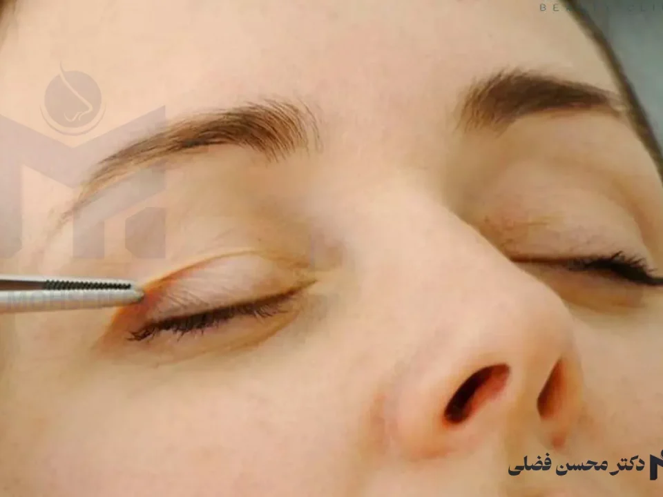 بلفاروپلاستی برای چه سنینی مناسب است؟