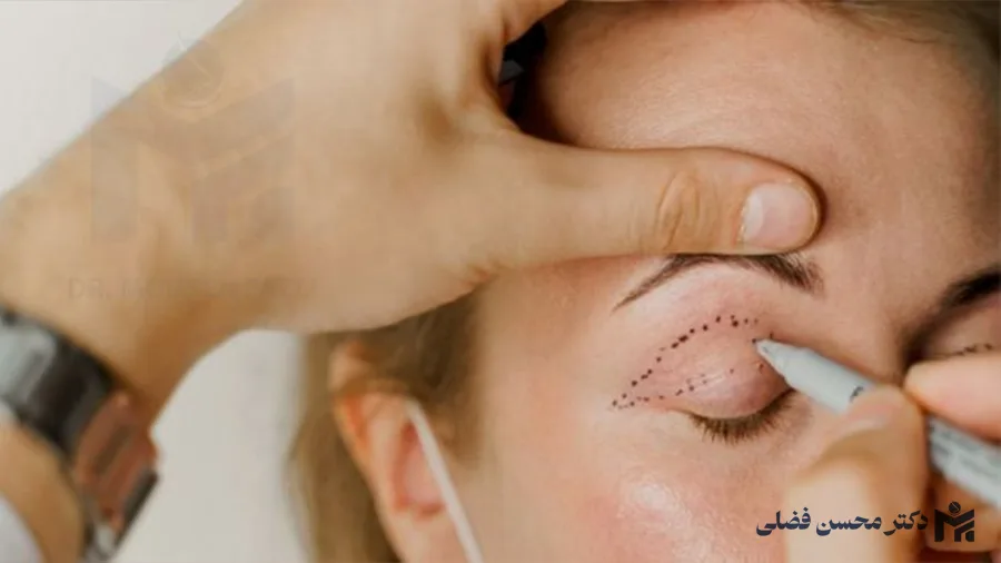 بلفاروپلاستی برای چه سنینی مناسب است؟