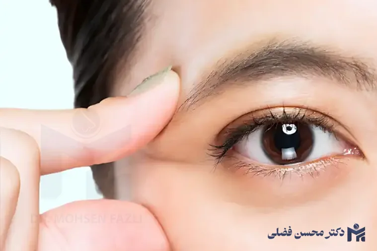 عمل کانتوپکسی چیست؟؛ راهکار موثر برای جوانسازی پلک چشم