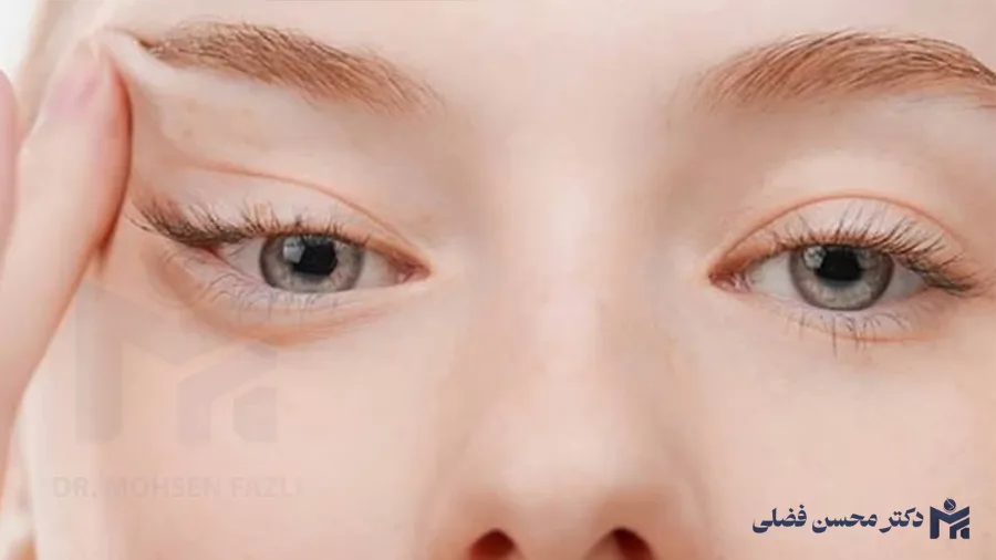 عمل کانتوپکسی چیست؟؛ راهکار موثر برای جوانسازی پلک چشم
