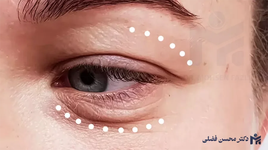 تأثیر لیفت ابرو بر بهبود میدان دید